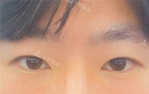韓國EH愛護整形外科術(shù)后一個月圖 韓國EH愛護整形外科術(shù)后一個月圖