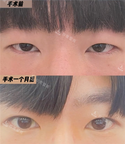 韩国EH爱护整形外科眼部整形对比