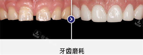韩国MINISH牙科医院牙齿损耗修复图