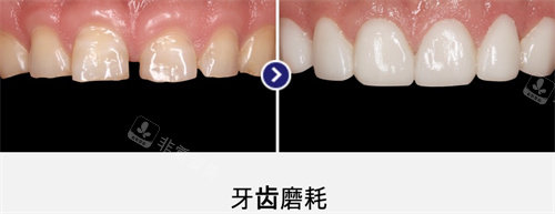 韓國MINISH牙科醫(yī)院牙齒損耗修復圖 韓國MINISH牙科醫(yī)院牙齒損耗修復圖