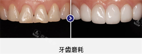 韩国MINISH牙科医院口腔修复对比图