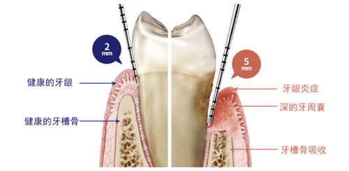 正常牙龈与牙龈萎缩对比图
