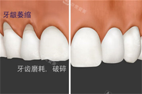 牙齦萎縮修復前后對比圖 牙齦萎縮修復前后對比圖
