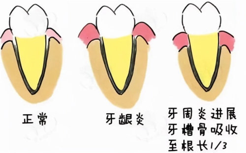 牙周病的發(fā)展史