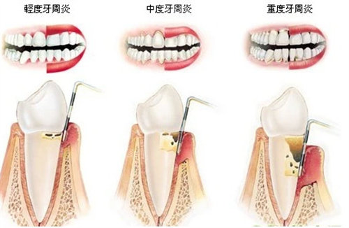 不同程度的牙周炎圖片