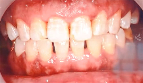 洗牙后牙齿间隙很明显图片