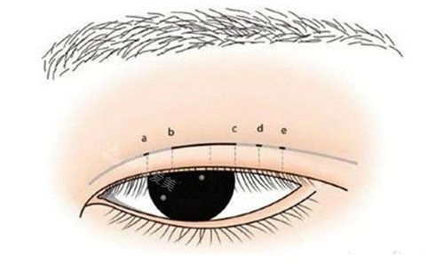 五点定位双眼皮动画展示图