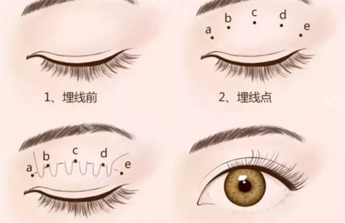 埋線法雙眼皮動畫圖
