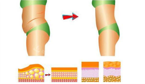 吸脂前后对比图