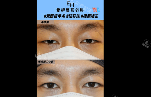 愛(ài)護(hù)整形男士提肌矯正視頻截圖 愛(ài)護(hù)整形男士提肌矯正視頻截圖