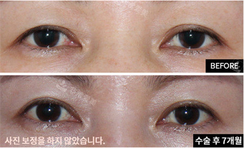 愛(ài)護(hù)整形眼部手術(shù)圖 愛(ài)護(hù)整形眼部手術(shù)圖