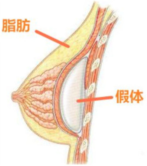 假體脂肪隆胸圖