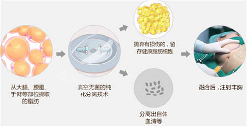 脂肪隆胸手术过程图