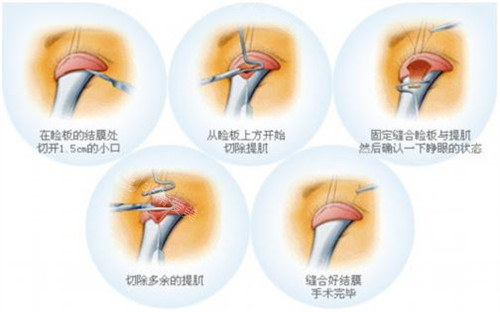 上睑下垂手术流程图
