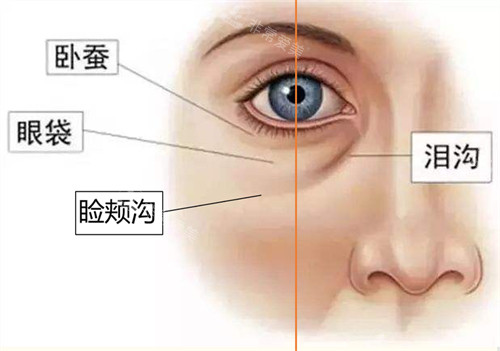 脸部卧蚕、眼袋、泪沟示意图