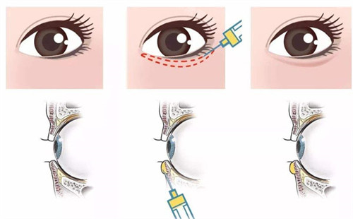 卧蚕手术过程与眼部横面示意图