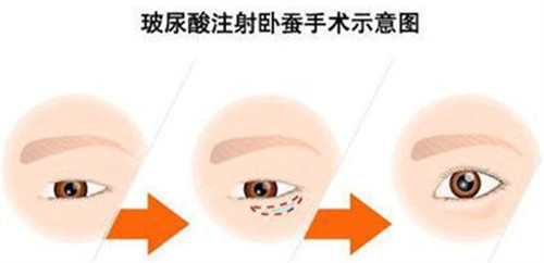 玻尿酸注射卧蚕手术示意图