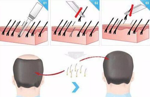 毛囊移植过程图