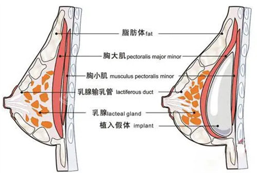 假体隆胸图