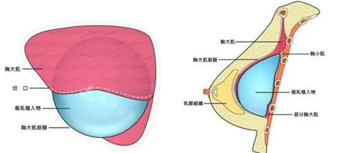 隆胸方式图