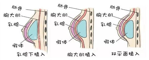 隆胸植入位置图