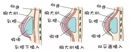 隆胸植入位置圖