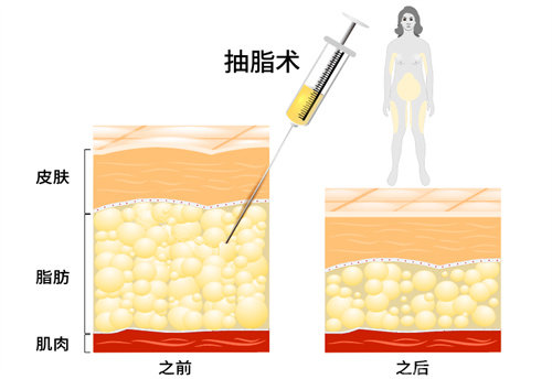 吸脂术动画说明图