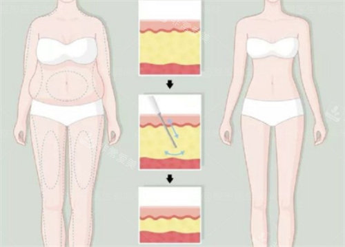 太原华晋医院整形科吸脂怎么样，定制吸脂量大对比明显！