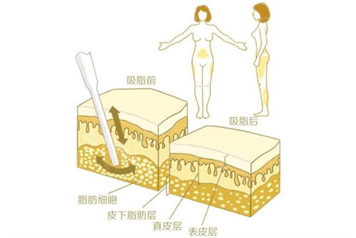 抽脂前后對(duì)比圖 抽脂前后對(duì)比圖