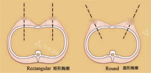 不同胸廓形状展示图