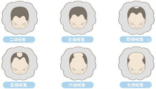 脫發(fā)的等級示意圖