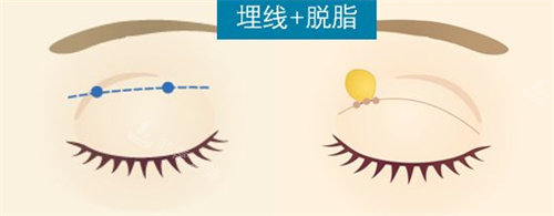 埋線+脫脂雙眼皮流程圖