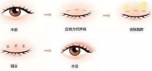 雙眼皮手術流程圖