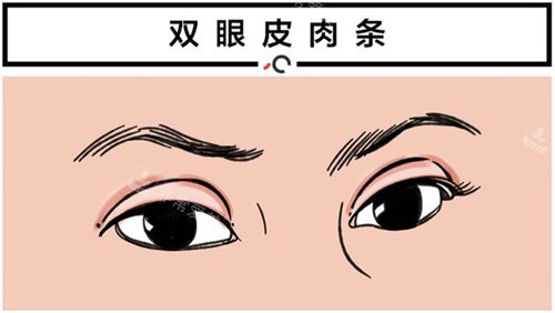 雙眼皮肉條動畫圖