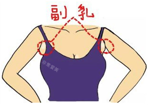 胸型副乳图