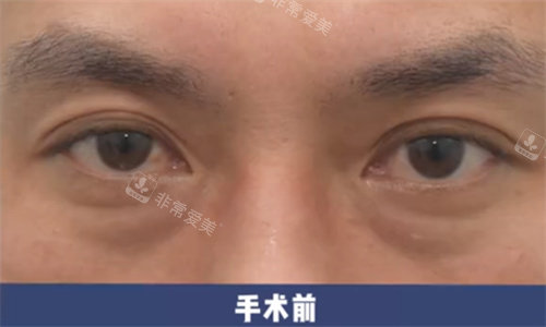 韓國來麗整形雙改單手術(shù)術(shù)前圖 韓國來麗整形雙改單手術(shù)術(shù)前圖