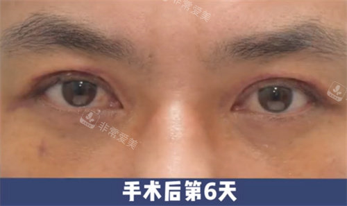 韓國來麗整形雙改單術(shù)后6天圖 韓國來麗整形雙改單術(shù)后6天圖