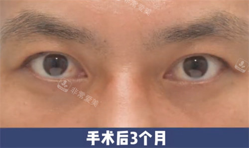 韓國來麗整形雙改單術(shù)后3個(gè)月圖 韓國來麗整形雙改單術(shù)后3個(gè)月圖