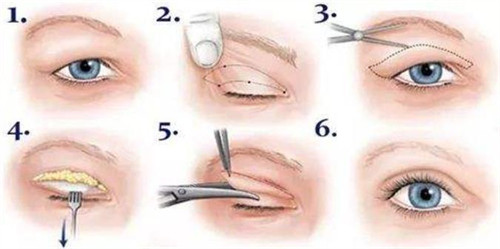 双眼皮修复流程图