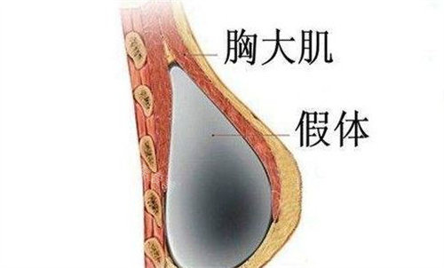隆胸假體放置位置展示圖 隆胸假體放置位置展示圖