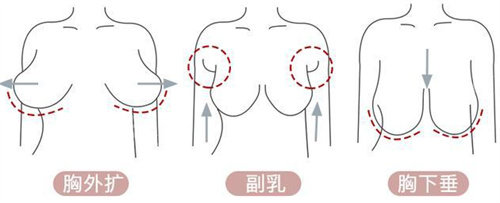 胸部外扩、下垂图