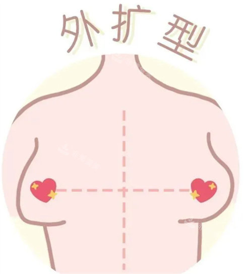 胸型外扩型图