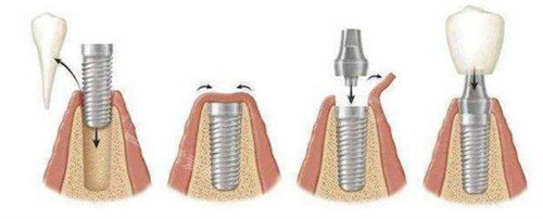 种植牙手术流程图