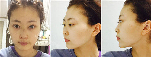 韩国格瑞丝噢爱美整形隆鼻亲身经历分享 术后1个月就很自然