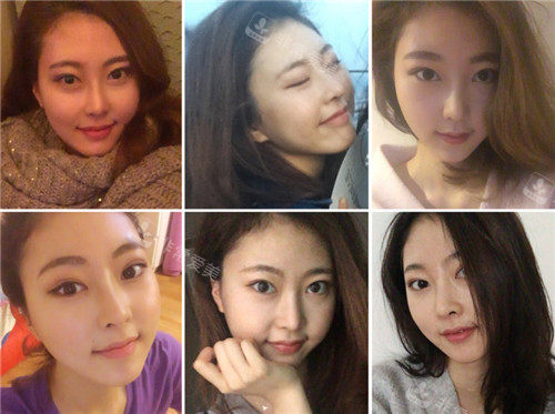 韩国格瑞丝噢爱美整形术后3个月照片