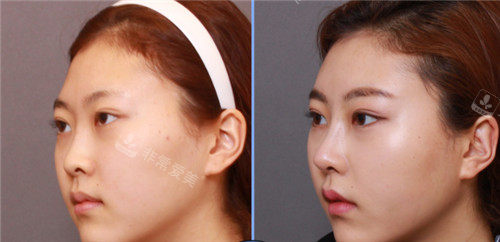 韩国格瑞丝噢爱美整形鼻子手术前后图
