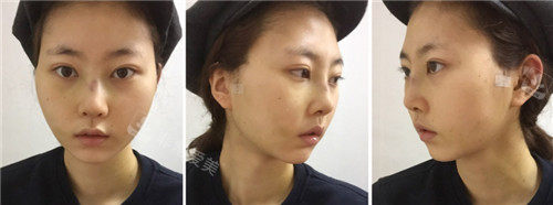 韩国格瑞丝噢爱美整形隆鼻亲身经历分享 术后1个月就很自然