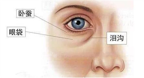 面部眼袋、卧蚕、泪沟示意图