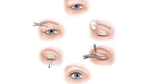 全切双眼皮流程图