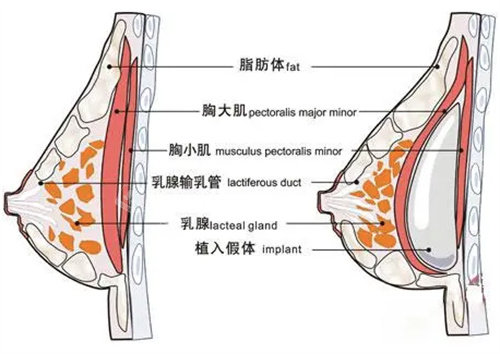 隆胸手术操作图.jpg